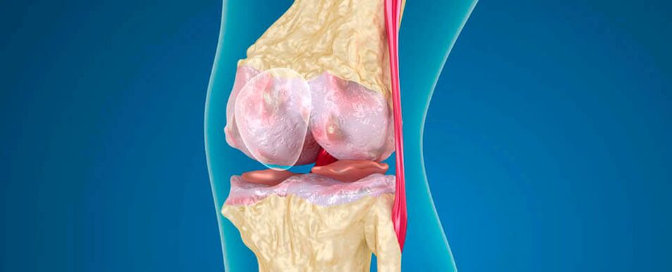 artroza kolana jako przyczyna bólu