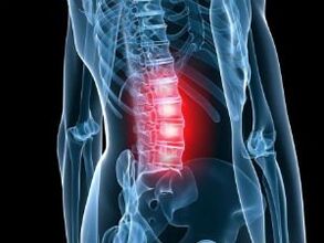 Osteochondroza kręgosłupa lędźwiowego
