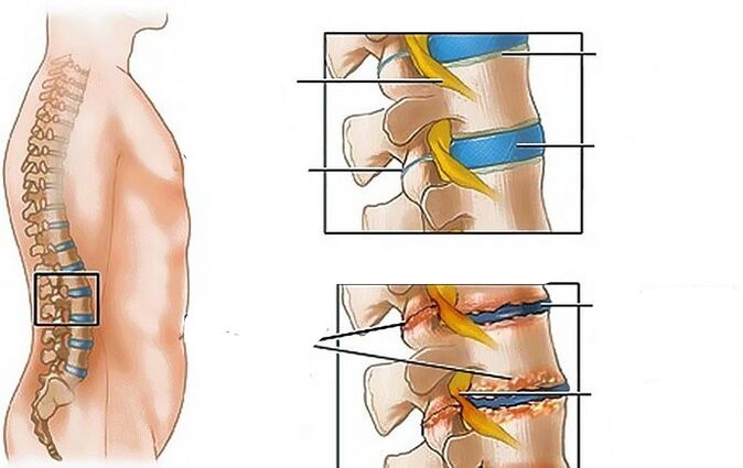 Osteochondroza obszaru lędźwiowego