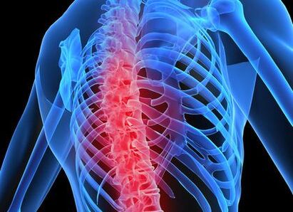 osteochondroza kręgosłupa piersiowego