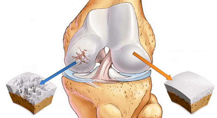 zdrowa chrząstka i chrząstka dotknięta chorobą zwyrodnieniową stawów