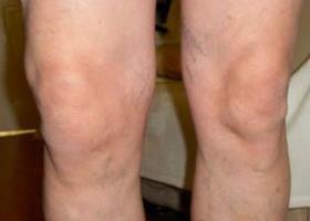 objawy kolana