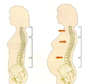 osteochondroza podczas ciąży